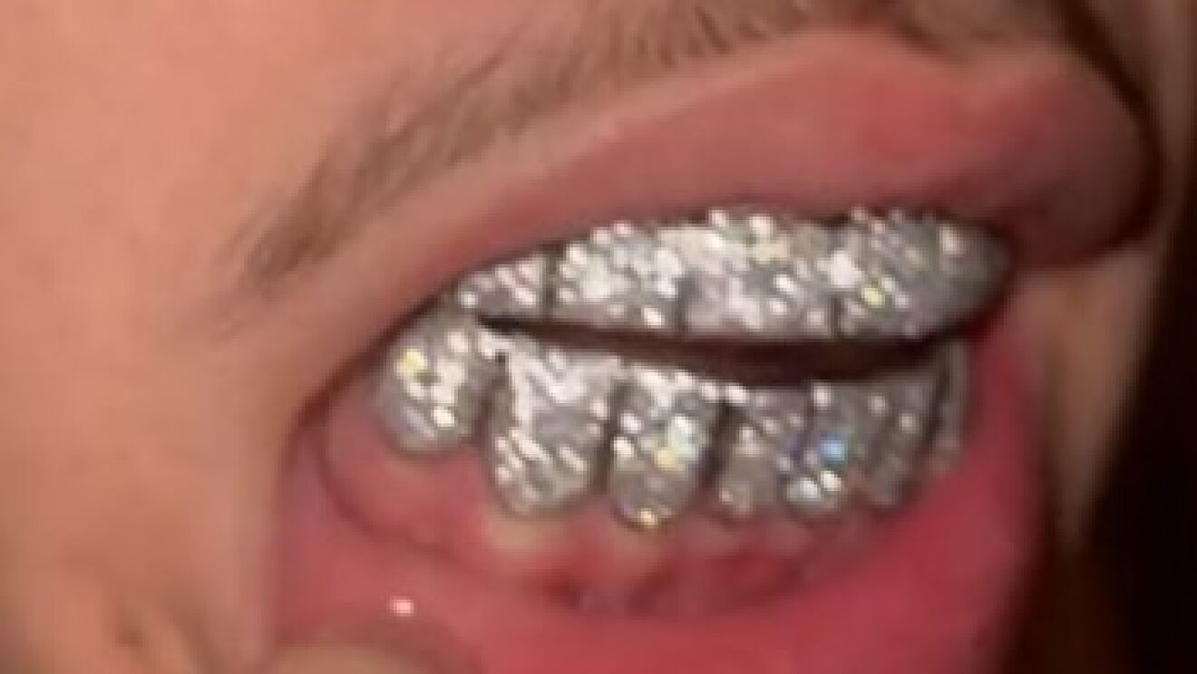 lamelo ball teeth Image 3